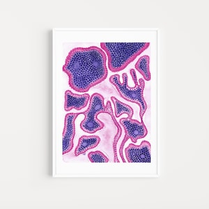 Warthin tumor art histology, head and neck histology, histology art, pathology art, watercolor histology, pathology gift
