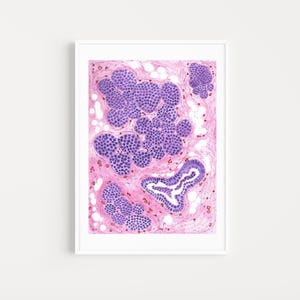 Lobular carcinoma in situ histology, Breast histology art, Breast oncologist gift,  breast histology printable, pathology lab wall decor