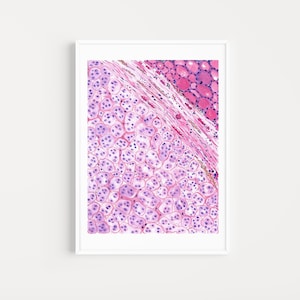 Thyroid tumor art print, pathology art printable, doctor office wall art, histology digital download, hyalinizing trabecular tumor