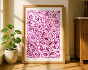 Invasives mikropapilläres Karzinom Histologie Aquarell Kunst (Digitaler Download), Medizintechnik, Brustpathologie