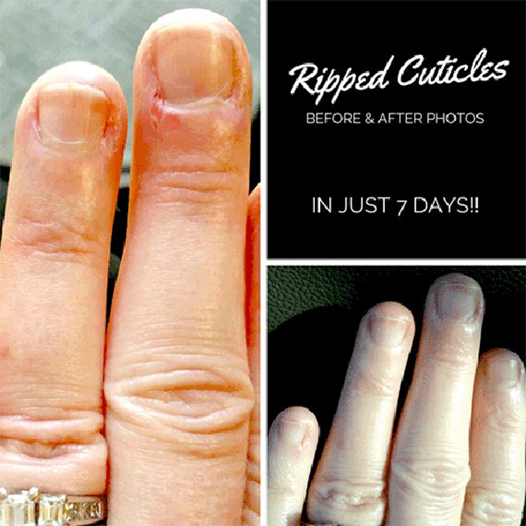 Cracked Finger Salve Split Cuticle Healing Butter Excellent Etsy