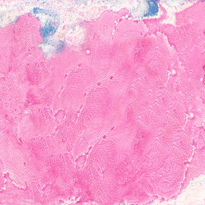 Pode incluir: Um close-up de uma amostra de tecido rosa e branco sob um microscópio. O tecido é densamente embalado com células e tem uma textura granulada.