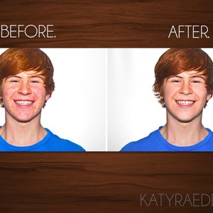 May include: Before and after photo of a young person with red hair. The photo on the left shows the person with acne on their face. The photo on the right shows the person with clear skin.