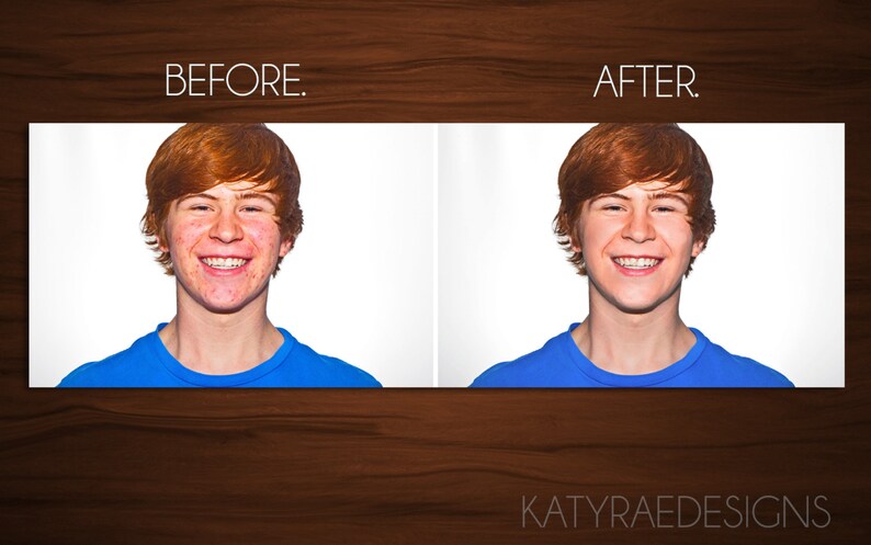 May include: Before and after photo of a young person with red hair. The photo on the left shows the person with acne on their face. The photo on the right shows the person with clear skin.