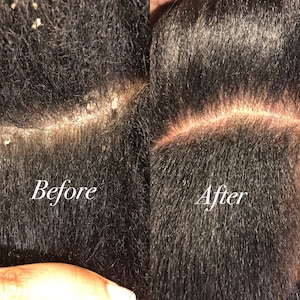 Puede incluir: Fotos de antes y despu&eacute;s que muestran la diferencia en la salud del cuero cabelludo. La foto de antes muestra un cuero cabelludo con escamas visibles, mientras que la foto de despu&eacute;s muestra un cuero cabelludo sano sin escamas.