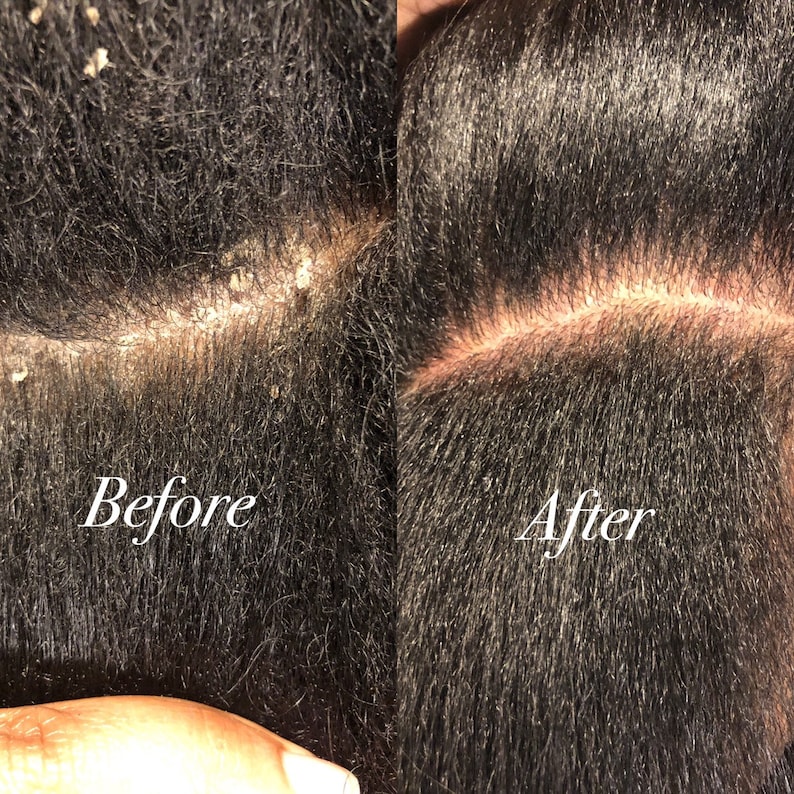 Apple Cider Vinegar Scalp Treatment for Dandruff,fungus,dermatitis Etsy