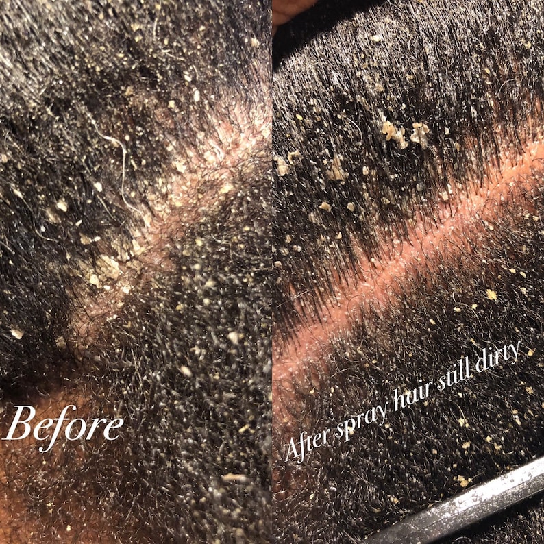 Puede incluir: Imagen de primer plano de un cuero cabelludo antes y despu&eacute;s de usar un spray para el cabello. La imagen anterior muestra un cuero cabelludo con caspa visible. La imagen posterior muestra el cuero cabelludo con caspa a&uacute;n presente. El texto "After spray hair still dirty" es visible en la imagen.