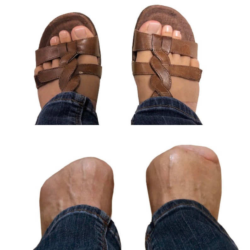 Silicone Toes Prosthetic for Underdeveloped/amputated Toes Etsy