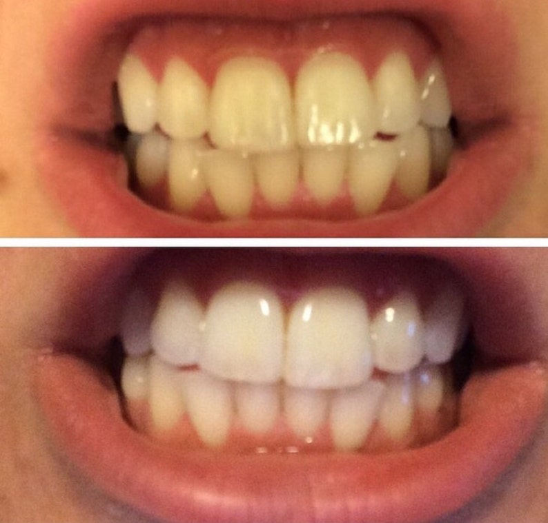 Teeth Whitening Treatment Activated Charcoal & Coconut Oil Paste image 3