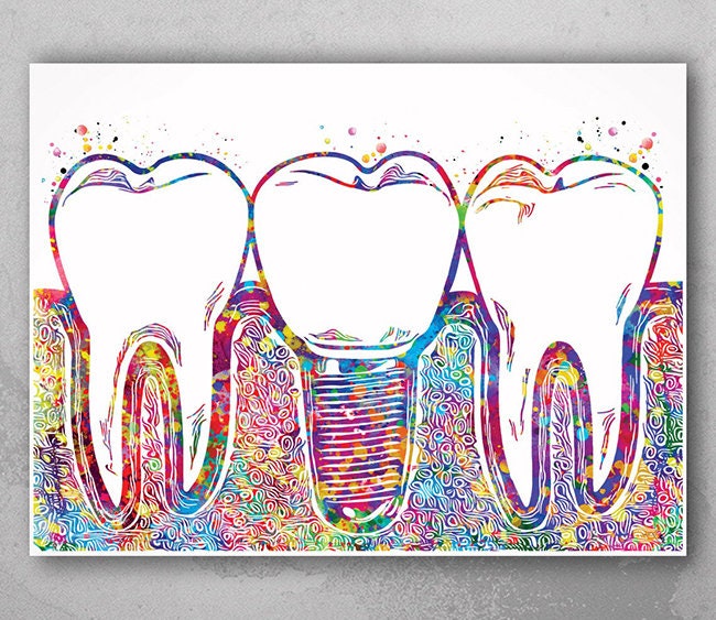 Prints Home & Living Home Décor Dental Implant Watercolor Print Tooth