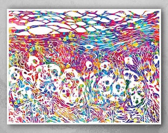 Skin Melanoma Histology Watercolor Print, Medical Biology Art-1198