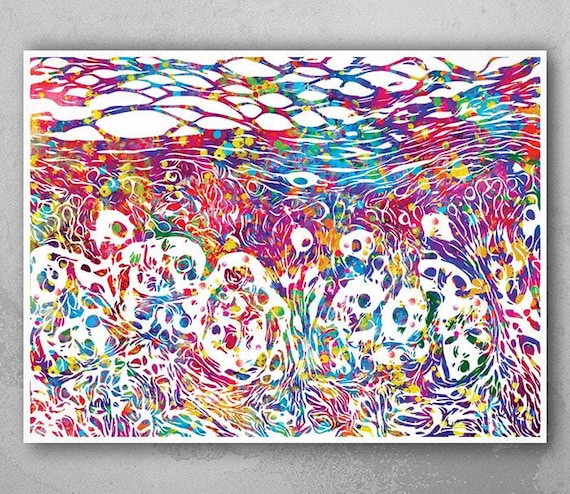 Skin Melanoma Histology Watercolor Print, Medical Biology Art-1198