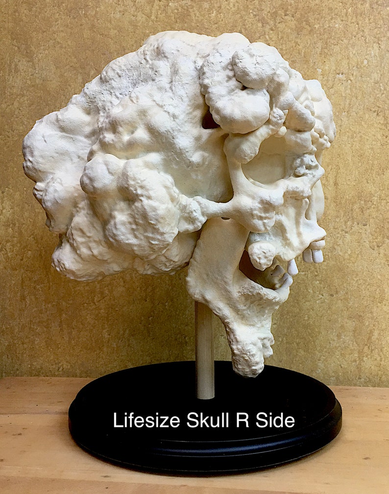 Joseph Merrick, The Elephant Man life-size skull reproduction image 3