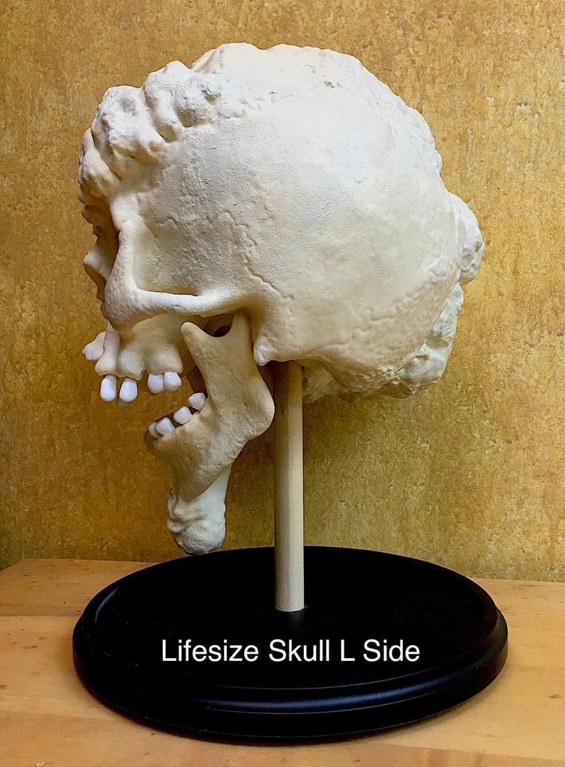 Joseph Merrick, The Elephant Man life-size skull reproduction image 2