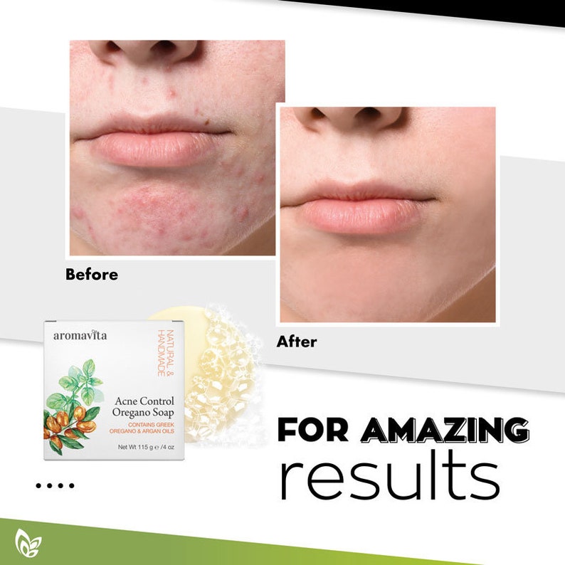 Acne Control Soap With Oregano & Argan Oils. Facial Soap Bar Etsy