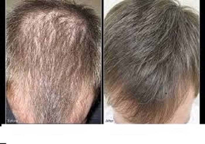 Alopecia Stimulating Scalp Oil60 Days Money Back - Etsy UK Alopecia Stimulating Scalp Oil60 Days Money Back - Etsy UK