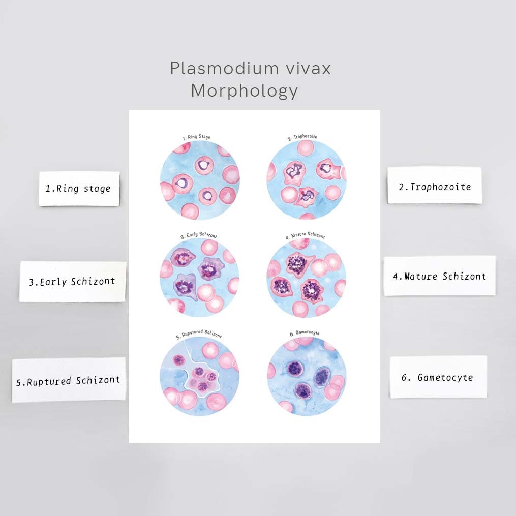 Malaria - Plasmodium vivax: Ring Stage Parasites