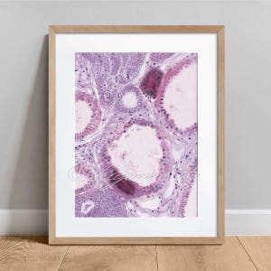 Calcification in the breast Histology Art Poster, Pathology Science Art Decor, Anatomy Watercolor Poster, Biology Decor Print Gift