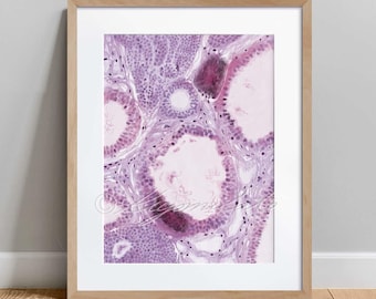 Calcification in the breast Histology Art Poster, Pathology Science Art Decor, Anatomy Watercolor Poster, Biology Decor Print Gift