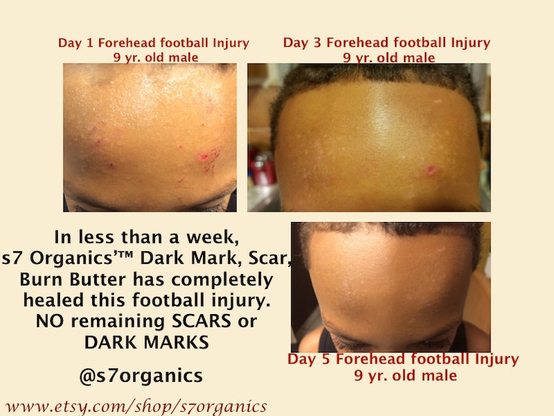 Dark Marks Scar Butter Burn Butter Dark Spots Healing Etsy