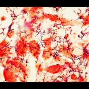 May include: Microscopic image of a biological sample, featuring a complex arrangement of red and purple structures against a light background. The image shows spiral-shaped organisms and irregular red masses, suggesting a medical or scientific context.