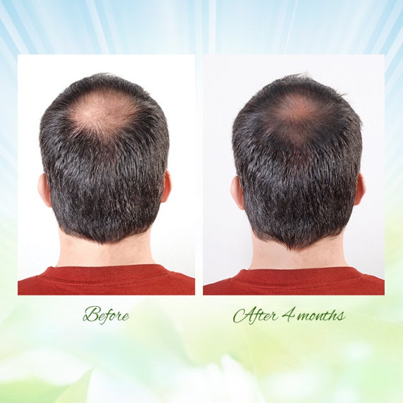 May include: Before and after photos showing the results of a hair loss treatment. The person in the photos has a receding hairline. The photo on the left shows the person's hair before treatment. The photo on the right shows the person's hair after 4 months of treatment. The hair appears to be thicker and fuller in the after photo.