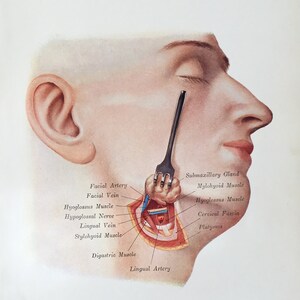 1906 Original Antique Anatomy print, Surgery - Ligature of the Lingual Artery, Medical illustration