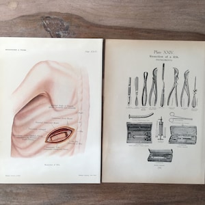1906 Original Antique Anatomy print - set of 2, Surgery - Resection of a Rib, Medical illustration