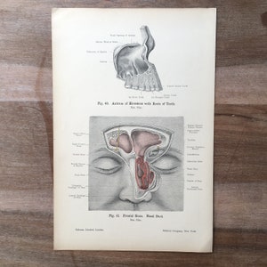 1906 Antique Medical print, Head Structure print, maxillary sinuses, Anatomy art engraving
