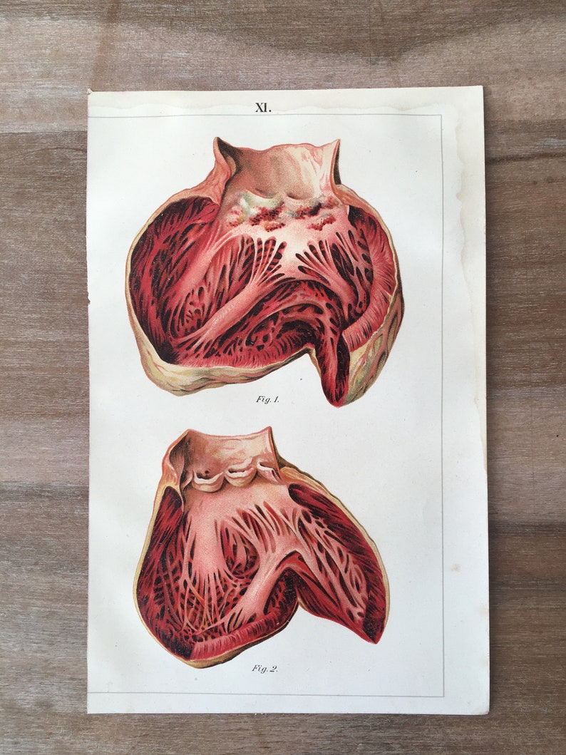 Human Diseases Heart Illustration Medical illustration Anatomy Print 1900 Original Antique Anatomy Lithograph set of 2 Heart diseases