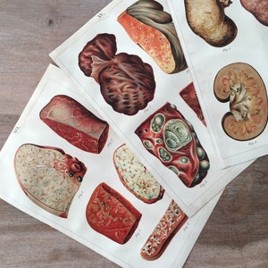 1900 Original Antique lithograph with Human Diseases, Anatomy print, Vintage Medical illustration set of 3