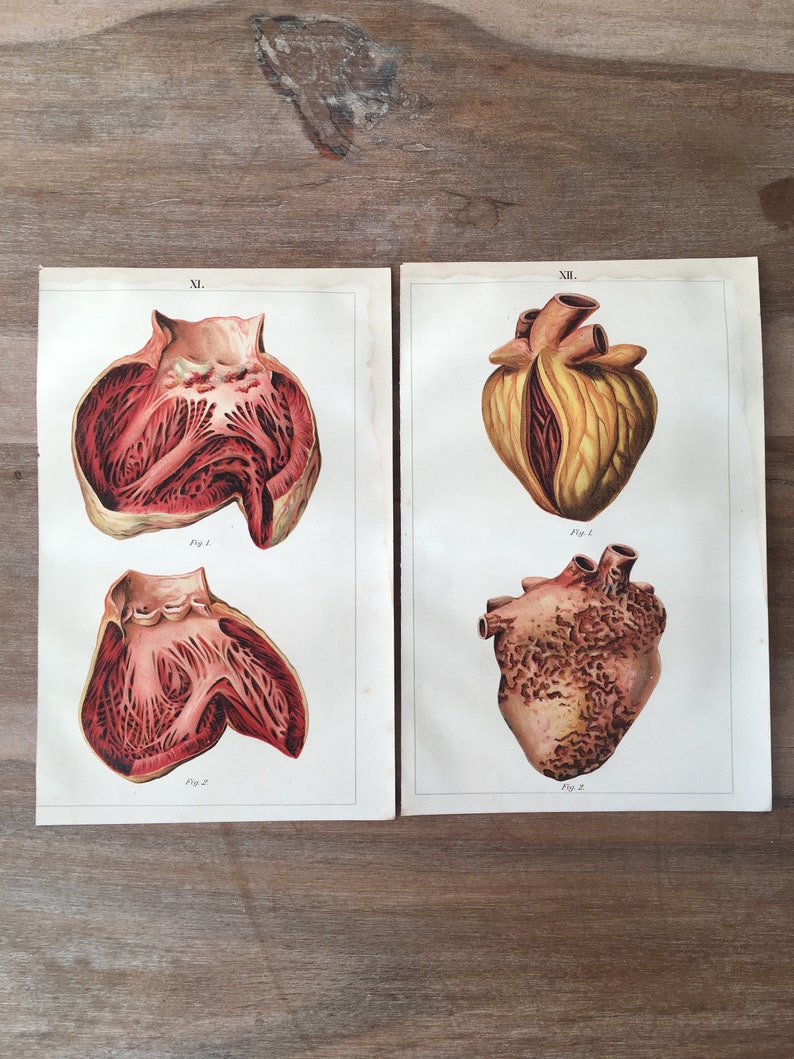 Human Diseases Heart Illustration Medical illustration Anatomy Print 1900 Original Antique Anatomy Lithograph set of 2 Heart diseases
