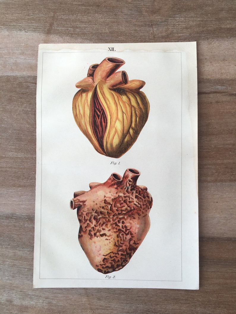 Human Diseases Heart Illustration Medical illustration Anatomy Print 1900 Original Antique Anatomy Lithograph set of 2 Heart diseases