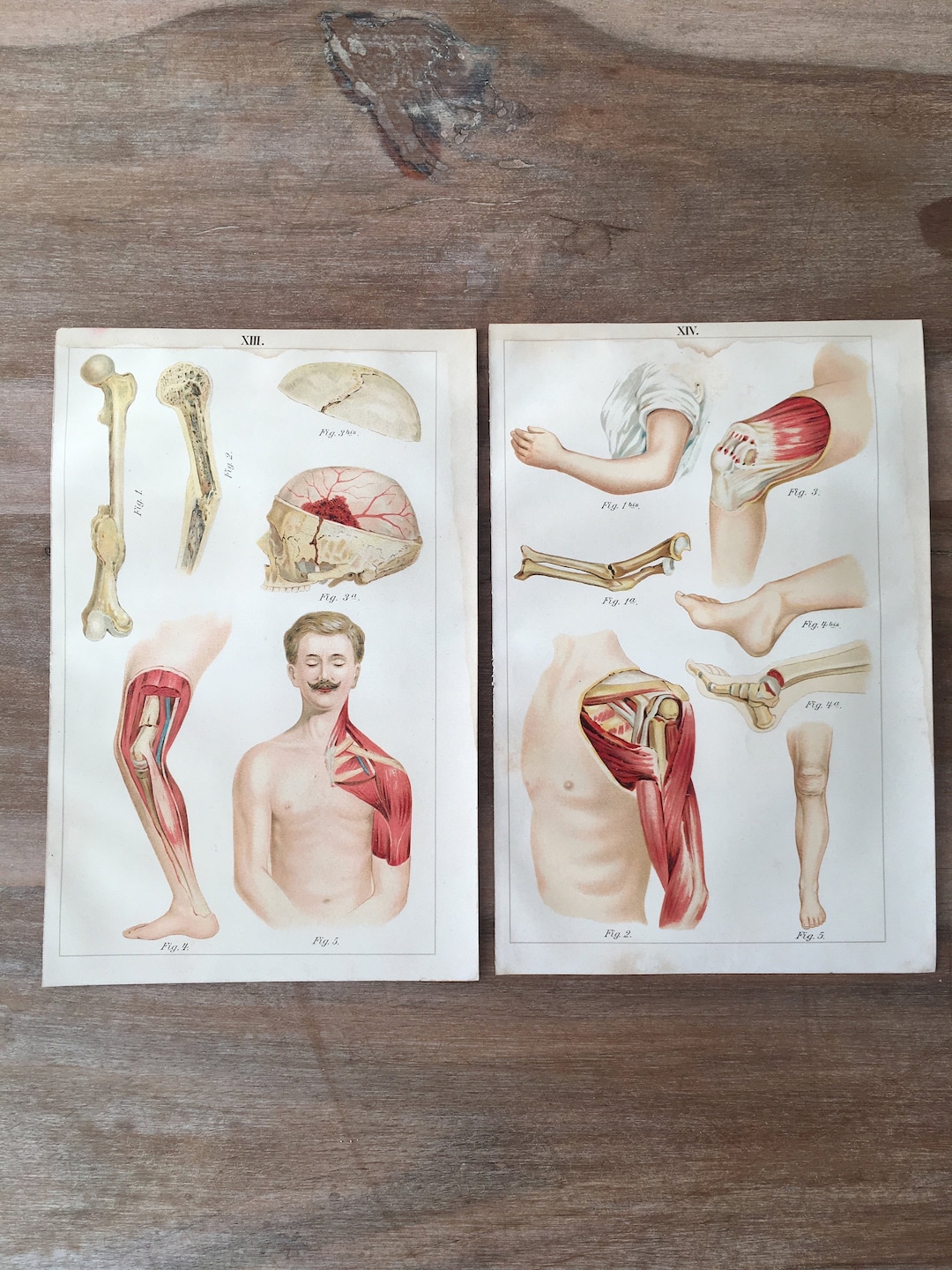 1900 Original Antique Lithograph With Human Bones Diseases, Anatomy ...