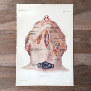 1906 Original Antique Anatomy print, Surgery - Cellulitis of Neck, Medical illustration
