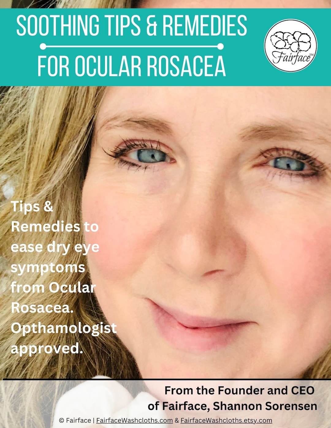 Ocular Rosacea Digital Guide, Dry Eyes Help, Ocular Rosacea Tips, Dry