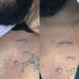 Keloid Hypertrophic Scar Dissolve Gel Madecassoside - Etsy Ireland Keloid Hypertrophic Scar Dissolve Gel Madecassoside - Etsy Ireland