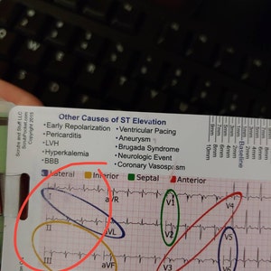 STEMI Reference Tool Vertical Badge Pocket Card for Nurse Paramedic RN ...