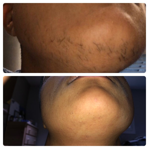 Amazing sugaring results testimonial