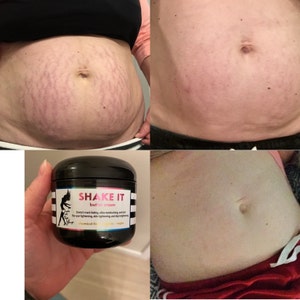 shake it cream for stretch marks