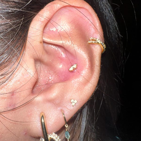 keloid scar pictures causes symptoms cream removal