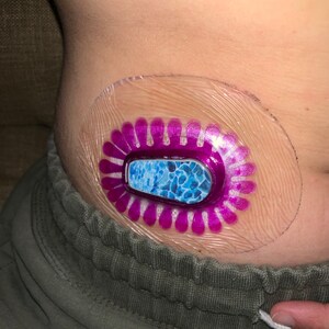 dexcom