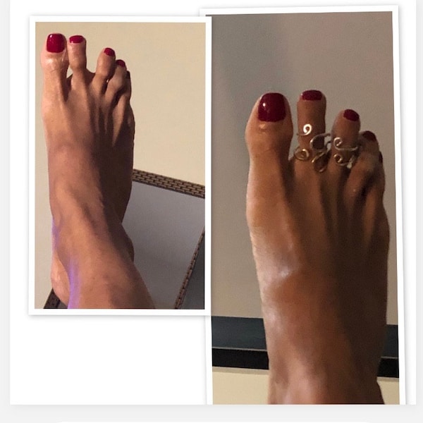 Toe Splint Two Rings Splint Adjustable Sterling Silver 925 - Etsy