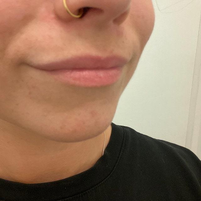 Nose Piercing Hole Scar