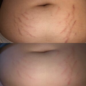 shake it cream for stretch marks