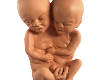 Siamese Twin Fetus Baby Fetal Specimen