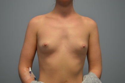 Athletic breasts