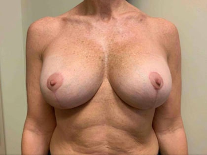 Asymmetrical breasts - Post cosmetic surgery