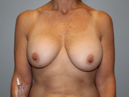 Asymmetrical Breasts
