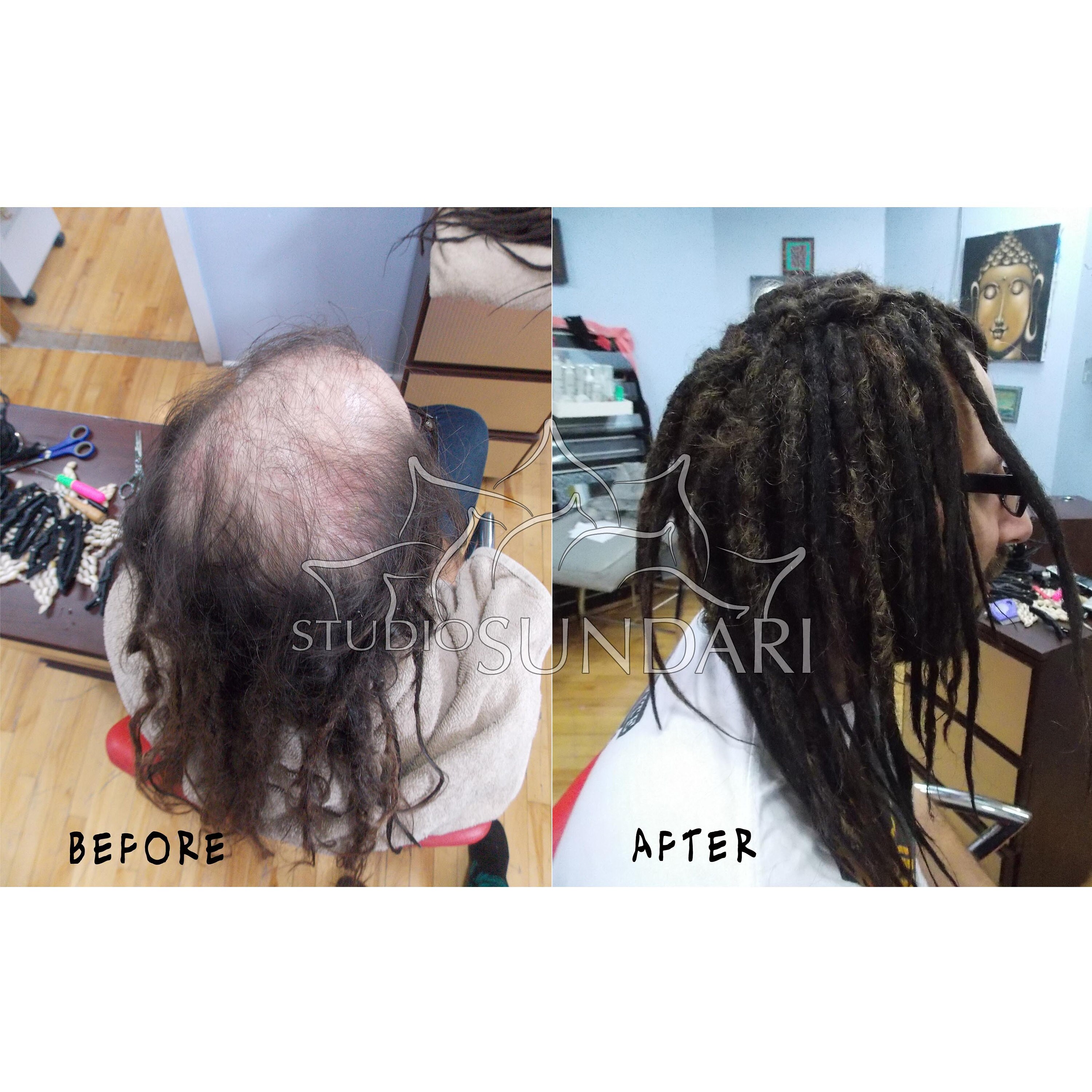 About Hair Loss